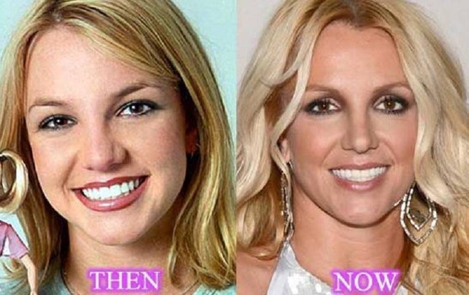Britney Spears Before And After Plastic Surgery Reveals Her Popstar Journey
